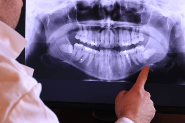Best Emergency Dentist for Lost Fillings or Crowns in Versailles, MO